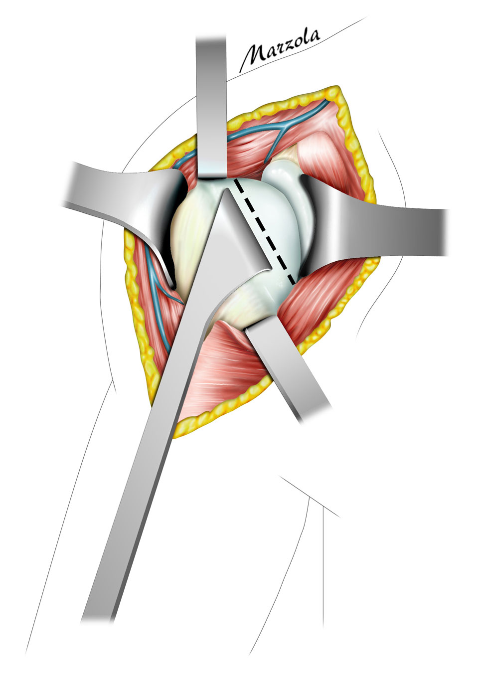 Osteotomia omerale